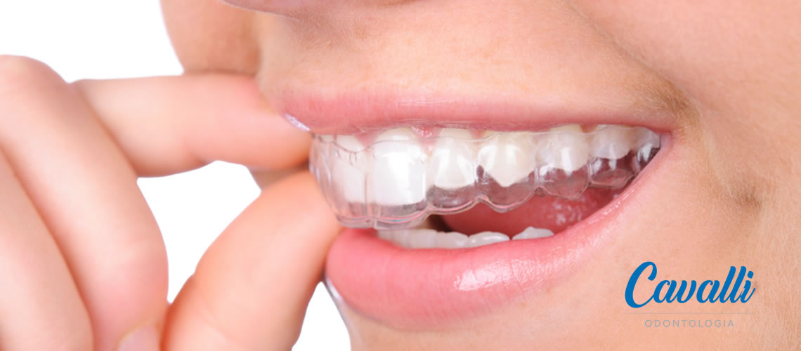 Alinhadores Dentais